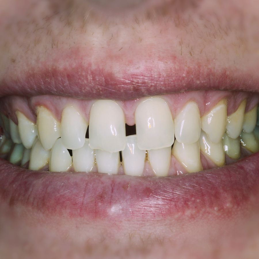 dental bonding - smile 1 - before - 3Dental